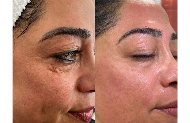 DS V Line Collagen IP Protokolü 1